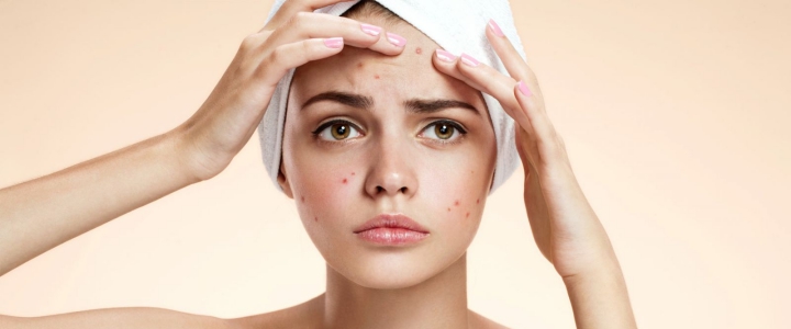 Resultado de imagen para ACNE