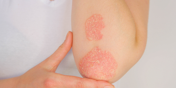 Psoriasis