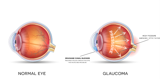 Glaucoma